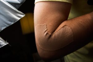 Read more about the article A Tecarterapia e a utilização de Kinesio taping na lesão aguda